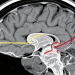 Sex-Specific Brain Volume Loss After Traumatic Brain Injury: Greater Impact in Older Women