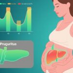 Unraveling the Drivers of Pruritus Severity in Intrahepatic Cholestasis of Pregnancy: Insights from a Longitudinal Cohort Study