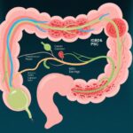 炎症性腸疾患と原発性硬化性胆管炎を有する患者の結腸直腸癌リスクの増加：スウェーデン全国コホートからの洞察
