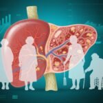 Sharp Rise in Advanced Alcohol-Related Liver Disease Despite Stable Drinking Rates: Changing Population Risks Highlighted by US Data