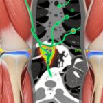 Parathyroidectomy Enhances Muscle Health in Postmenopausal Women with Primary Hyperparathyroidism