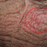 Scrotal Eczema: Understanding, Treating, and Preventing This Common Yet Distressing Condition