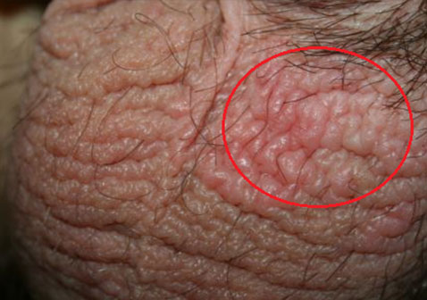 Scrotal Eczema: Understanding, Treating, and Preventing This Common Yet Distressing Condition