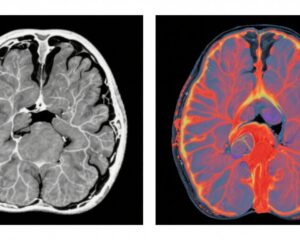 非造影CTとCT灌流画像の急性脳卒中における比較: 最新試験と体系的レビューからの洞察