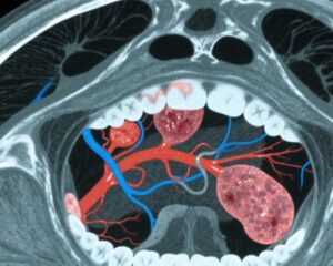 Adjuvant Chemoradiotherapy in Oral Cavity SCC: Distinguishing Benefits Between Minor and Major Extranodal Extension