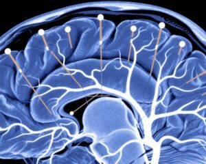 Acupuncture Enhances Brain White Matter Integrity and Alleviates Postconcussion Symptoms in Mild TBI: Evidence from a Randomized Controlled MRI Study