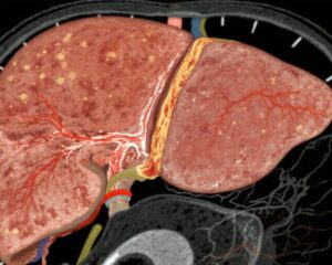 HTD1801 Hiển Thị Sự Cải Thiện Tổ Chức Hứa Hẹn trong Steatohepatitis Liên Quan đến Rối Loạn Chức Năng Chuyển Hóa: Những Hiểu Biết từ Nghiên Cứu Tiền Lâm Sàng và Giai Đoạn 2