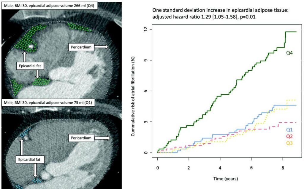 Epicardial Adipose Tissue as a Predictor of New-Onset Atrial Fibrillation: Insights from a Danish Population Cohort