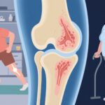 Exercise Alone Matches Diet Plus Exercise for Hip Osteoarthritis Pain Relief, Large Randomized Trial Shows