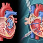 Percutaneous versus Surgical Approaches in Aortic Stenosis with Complex Coronary Disease: TCW Trial Insights