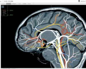 Advancing Radiotherapy in High-Grade Glioma: Targeted Volume Reduction with Hypofractionated Simultaneous Boost IMRT