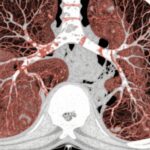 Nerandomilast for Idiopathic and Progressive Pulmonary Fibrosis: Phase 3 Trial Insights