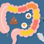 Four Typical Early Signs of Colorectal Cancer: What to Watch For