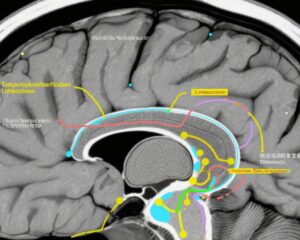 Hoạt động thể chất làm chậm thoái hóa thần kinh và suy giảm nhận thức ở bệnh nhân Parkinson giai đoạn đầu: Kết quả từ phân tích MRI theo thời gian