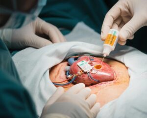 Giảm Nguy Cơ Nhiễm Trong Phẫu Thuật Lặp Lại CIED bằng Màn Che Ngâm Iốt: Nhận Định từ Một Thử Nghiệm Lâm Sàng Ngẫu Nhiên