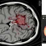 Thử nghiệm OPTIMAS: Chống đông sớm so với muộn trong đột quỵ thiếu máu não cấp tính kèm theo rung nhĩ và bệnh thận mạn tính