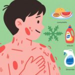 蕁麻疹の発症原因と日常生活でよく見られる誘因とは？