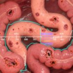 EASE-CD: A Validated Endoscopic Ulcer Activity Score for Crohn’s Disease—Clinical Utility and Evidence from Randomized Trials