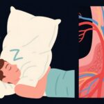 Đối với việc sử dụng gối cao có thể gây ra đột quỵ? Hiểu rõ nguyên nhân của đột quỵ não