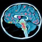 Elevated Risk of Alzheimer’s Disease and Related Dementias in Transfeminine Adults: Insights from a Large Cohort Study