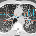 Comparative Efficacy and Safety of Prednisone and Methotrexate as First-Line Treatments for Pulmonary Sarcoidosis