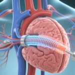 Routine Use of Cerebral Embolic Protection in TAVI: Evidence, Outcomes, and Clinical Implications