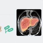 Flaxseed Powder Supplementation: Emerging Evidence in Non-Alcoholic Fatty Liver Disease and Metabolic Health