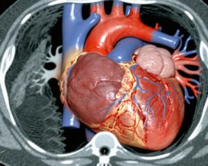 Tirzepatideの効果：HFpEFと肥満における糖尿病の影響 – SUMMIT試験の解明
