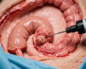 评估息肉切除术后成人高危新生物的风险：50岁以下与50岁以上