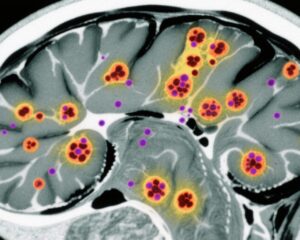 High-Dose Aumolertinib Demonstrates Promising Efficacy in Untreated EGFR-Mutant NSCLC with Brain Metastases: Insights from the ACHIEVE Phase 2 Trial