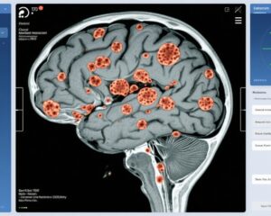 脑转移瘤术前与术后立体定向放射治疗：一项3期随机试验的安全性、可行性和效率见解