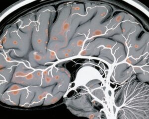 Phenotype Bệnh Mạch Máu Nhỏ Đặc Trưng Liên Quan đến Biến Thể Mất Chức Năng Monoallelic NOTCH3: Phân Biệt từ CADASIL và Ý Nghĩa Lâm Sàng