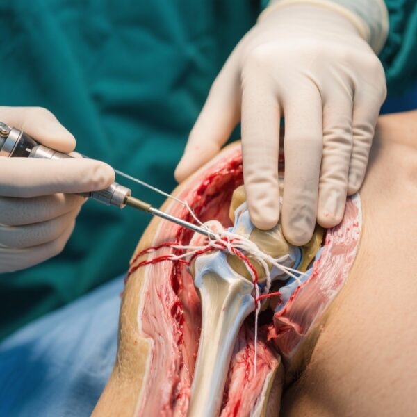 Đánh giá Kết quả Dài hạn của Kỹ thuật Phẫu thuật Arthroscopic Bankart Hiện đại trong Bất ổn Trước Vai do Chấn thương: Những hiểu biết từ Nghiên cứu Theo dõi 10 năm