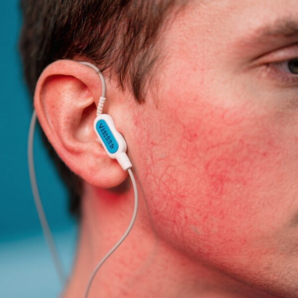 Transcutaneous Auricular Vagus Nerve Stimulation: A Promising New Therapy for Erythematotelangiectatic Rosacea