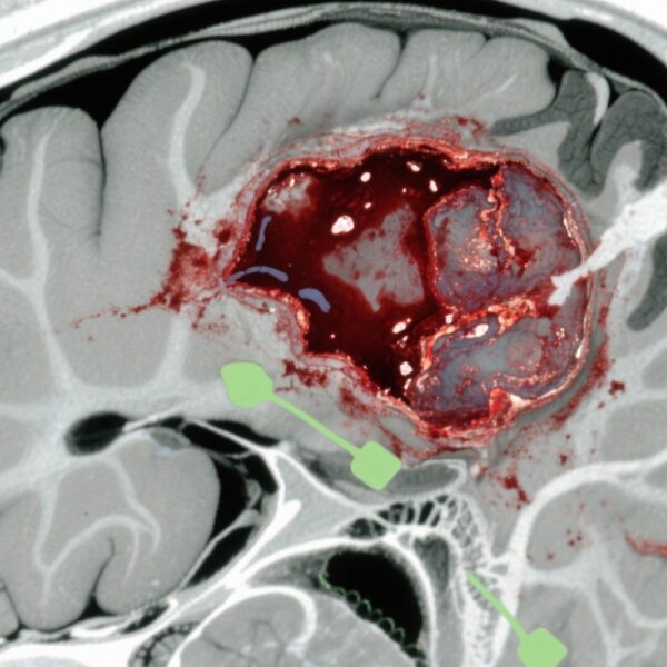 外傷性急性硬膜下血腫の治療バランス：急性手術と保存療法