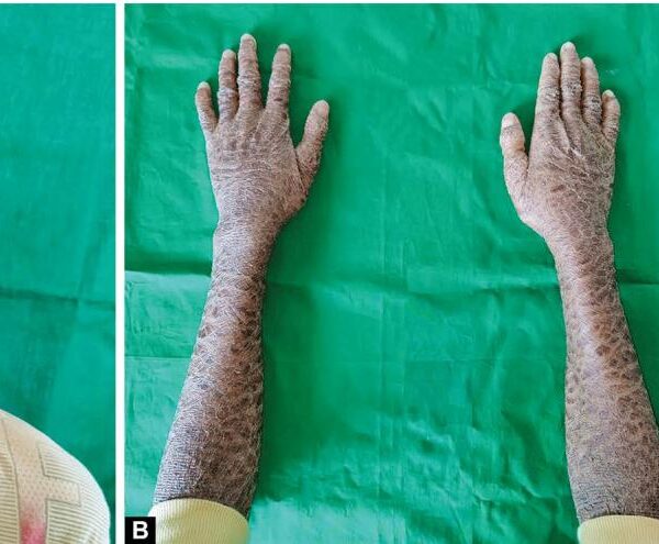 Oral Manifestations of Lamellar Ichthyosis: A Case Report of Two Siblings