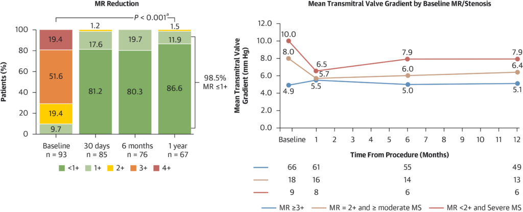 Transseptal TMVR Using the SAPIEN M3 System: 1-Year Outcomes in Patients with Mitral Annular Calcification from the ENCIRCLE MAC Registry